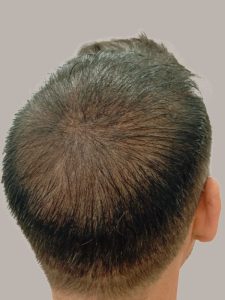 Retoque hairline, estilo cerquillo americano