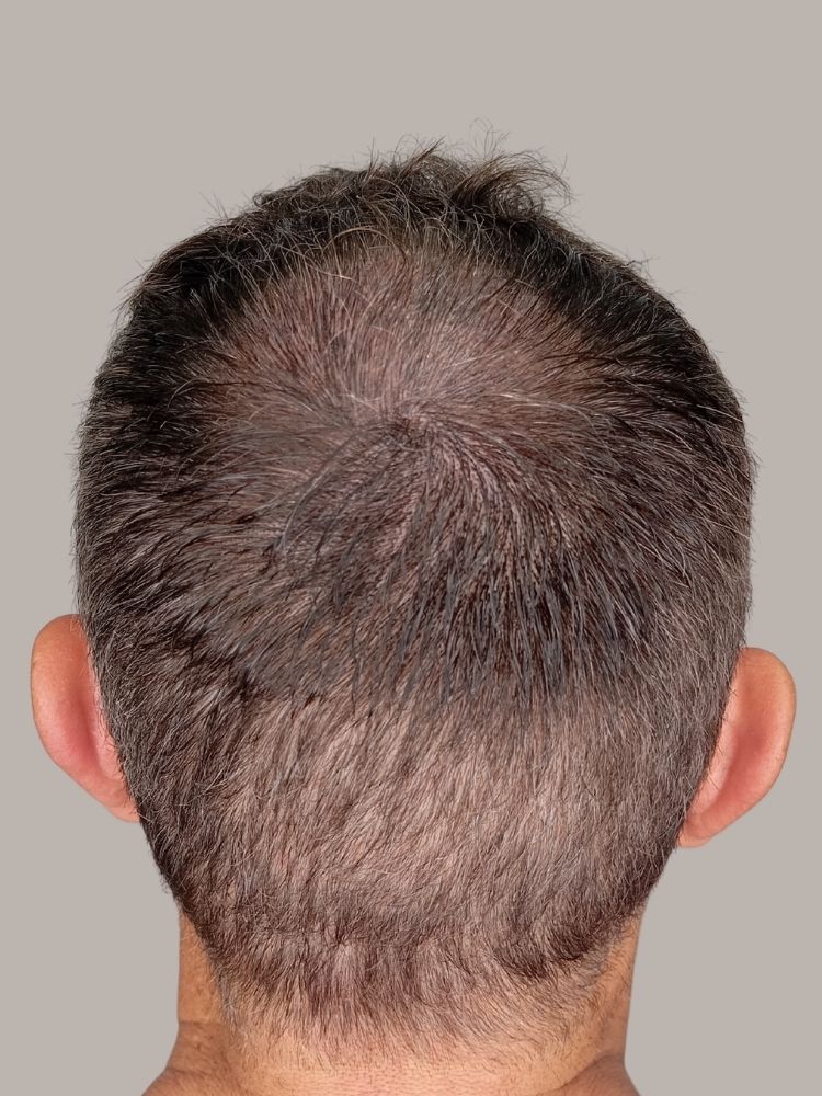 Foto después de primera sesión de micropigmentación capilar